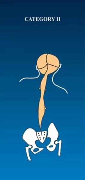 Category II - Pack of 100