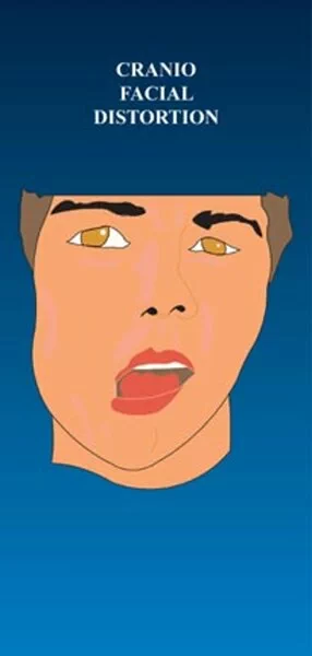 Cranio-Facial Distortion - Pack of 100